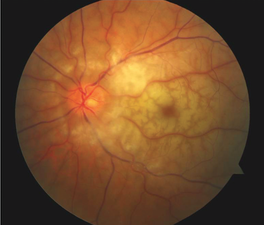 How to Manage Cotton Wool Spots on the Retina