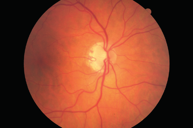 papilledema vs glaucoma