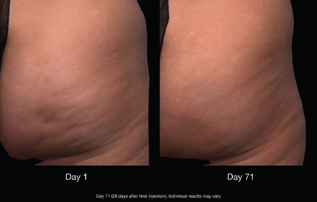 endo cch cellulite