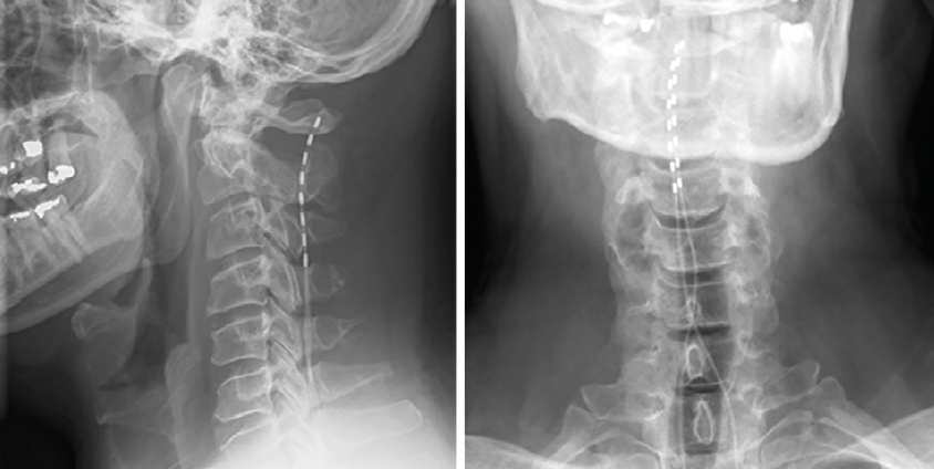 Spinal Cord Stimulation for Chronic Back and Neck Pain