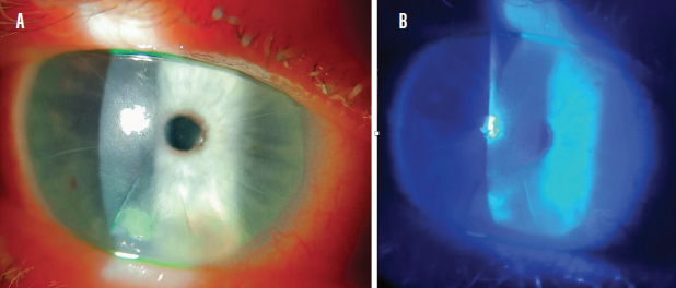 Amniotic Membranes To The Rescue - Modern Optometry