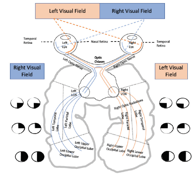 Consulting Patients With Hemianopic Visual Field Cuts Modern Optometry