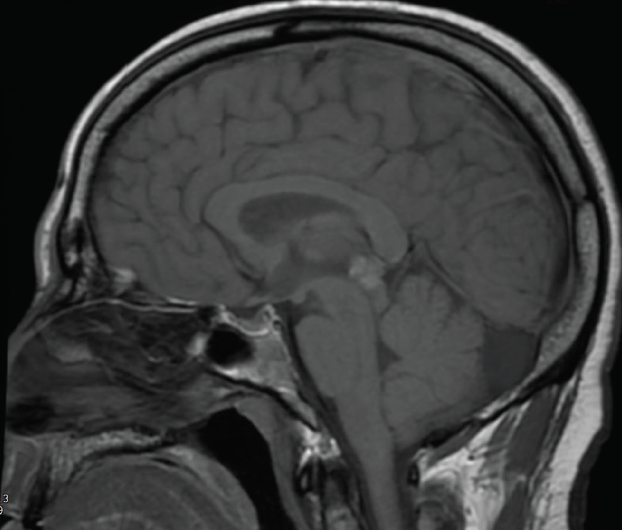An Unusual Sudden Onset of Diplopia Modern Optometry