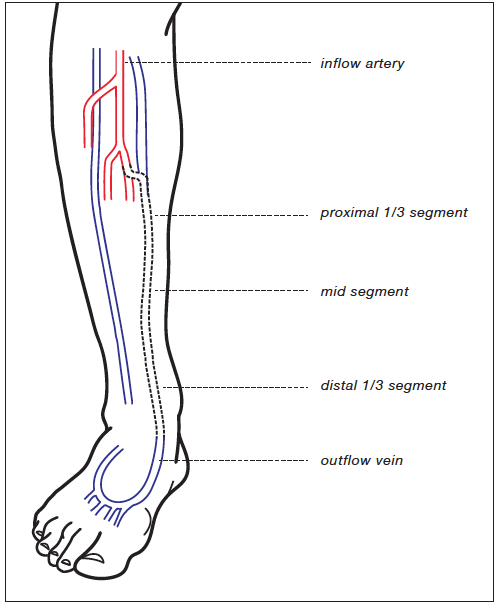 Hybrid superficial venous arterialization and endovascular deep venous  arterialization - Journal of Vascular Surgery Cases, Innovations and  Techniques
