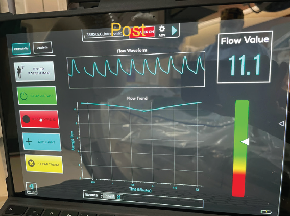 blood flow monitor