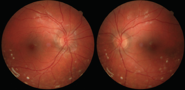 Screening for Biomarkers of Lyme-Related Infection - Modern Optometry