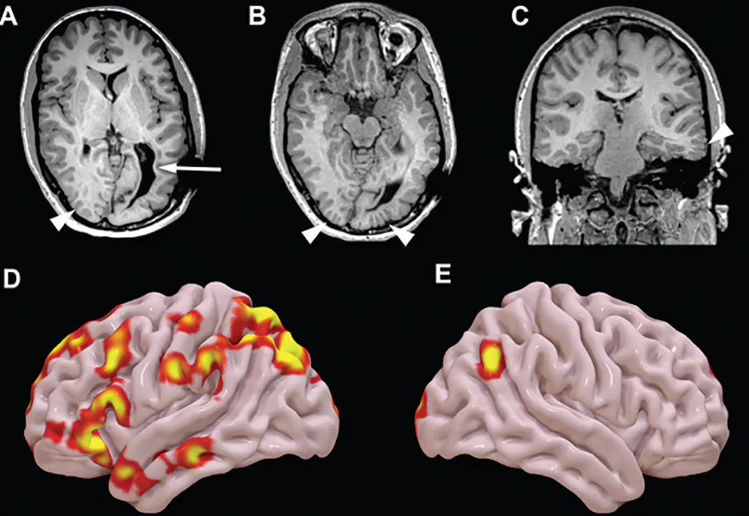 Epilepsy Brain Mri Magnetization Transfer MR Imaging In Patients With