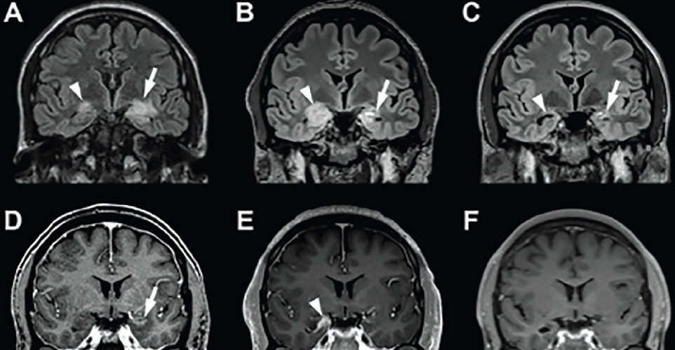 Lorazepam 1 mg for mri