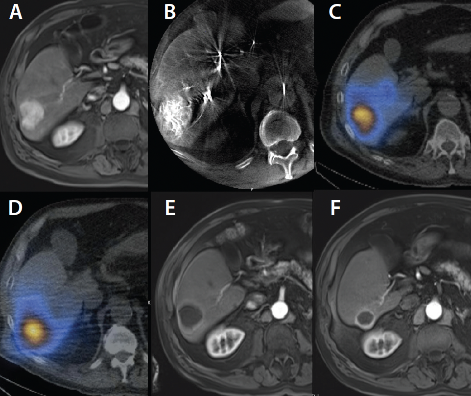 A Practical, Case-Based Approach to Yttrium-90 Radioembolization Dosimetry  in the Liver - Endovascular Today