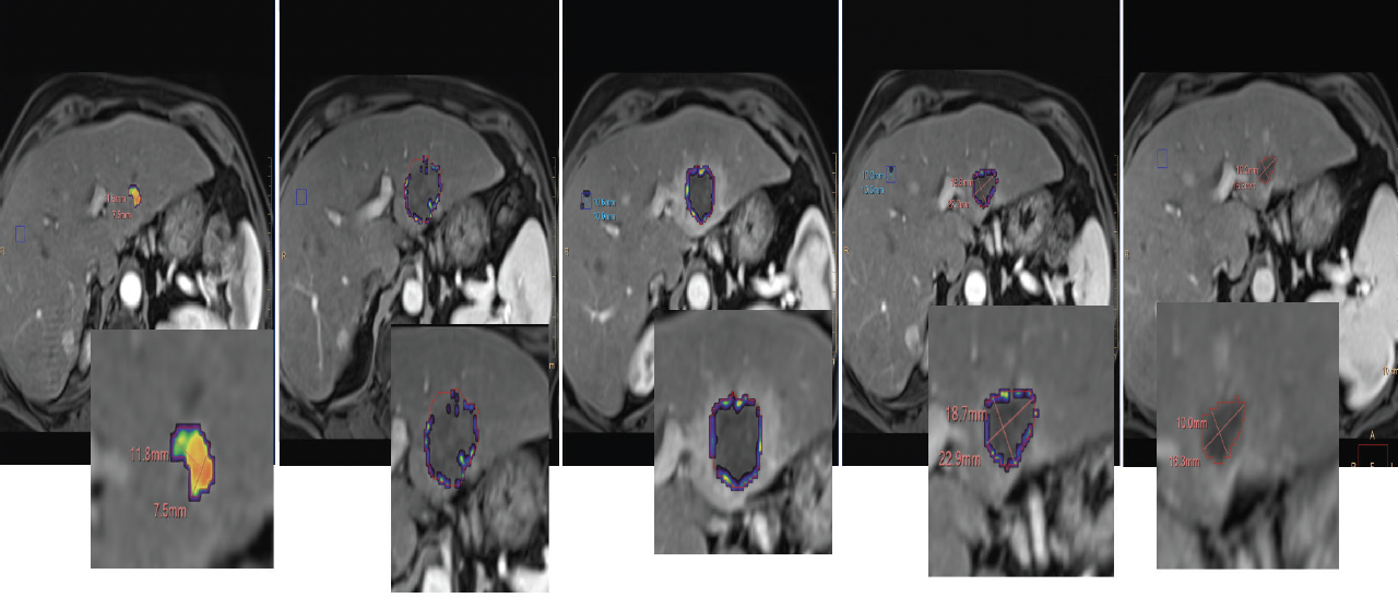 Interventional Oncology Fast Forward To The Future Endovascular Today   1021 F7 Fig1 