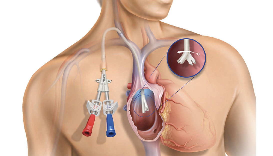The Pristine™ Long-Term Hemodialysis Catheter: Physicians' Perspectives - Endovascular Today
