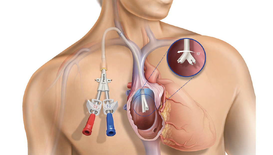 the-pristine-long-term-hemodialysis-catheter-physicians-perspectives