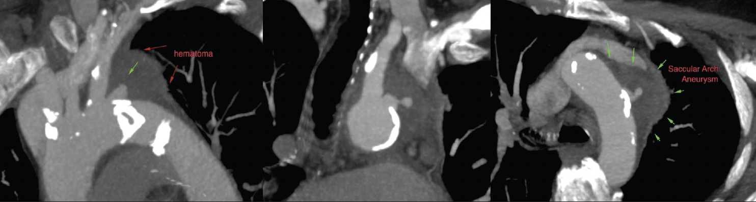 Real-World Use of the Castor™ Branched Aortic Stent Graft System for ...