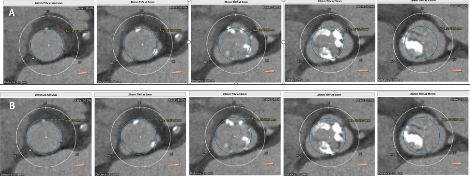 Circle Method for Bicuspid Screening - Cardiac Interventions Today