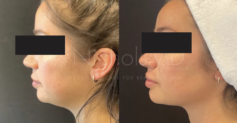 Jawline Contouring Treatment with Injectables - Practical Dermatology