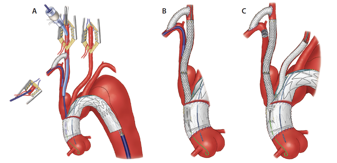 Endovascular Total Arch Repair - Endovascular Today