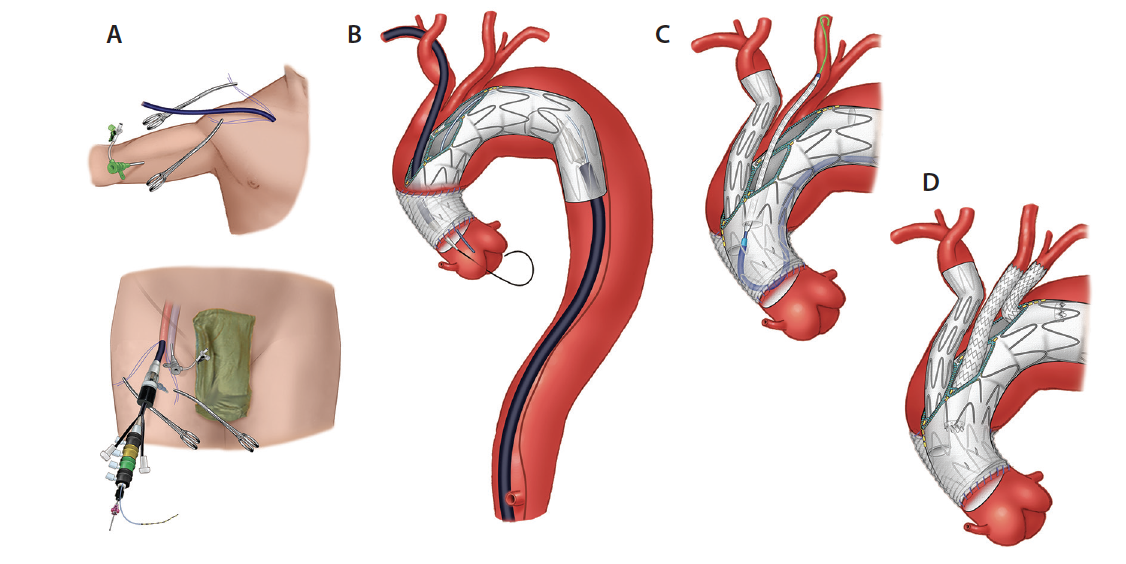 Endovascular Total Arch Repair Endovascular Today