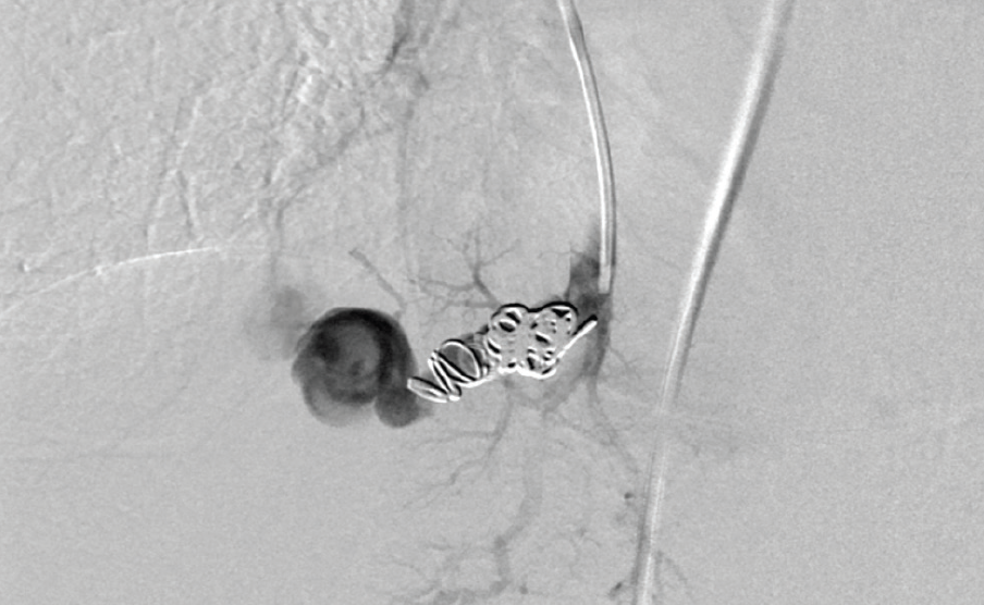 Coil Technology Sizes, Shapes, and Capabilities Endovascular Today