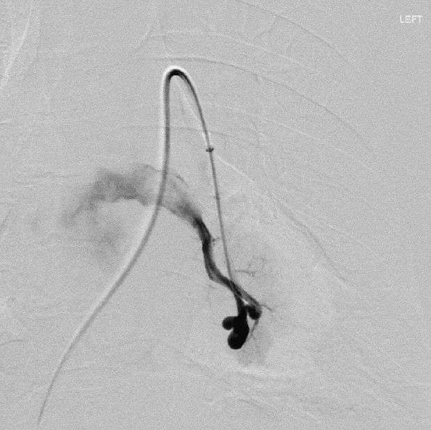 Pulmonary Arteriovenous Malformations: Current Guidelines ...