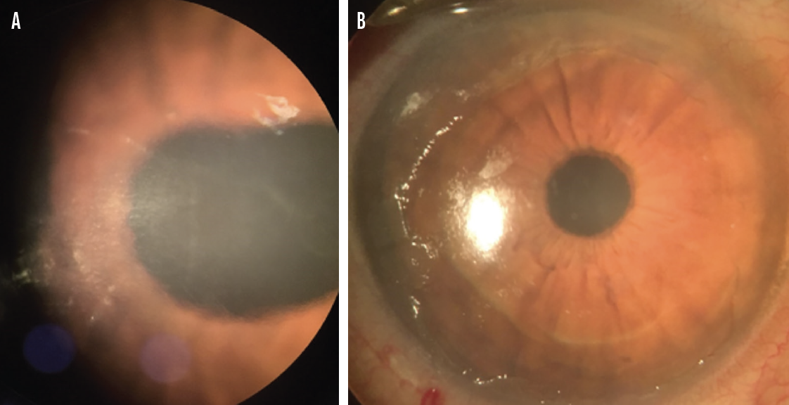 Superficial Keratectomy: A Versatile In-Office Procedure - Modern Optometry