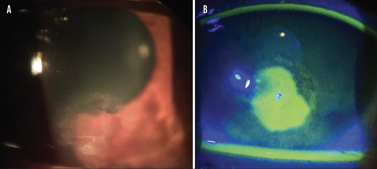 Superficial Keratectomy a Versatile InOffice Procedure Modern Optometry