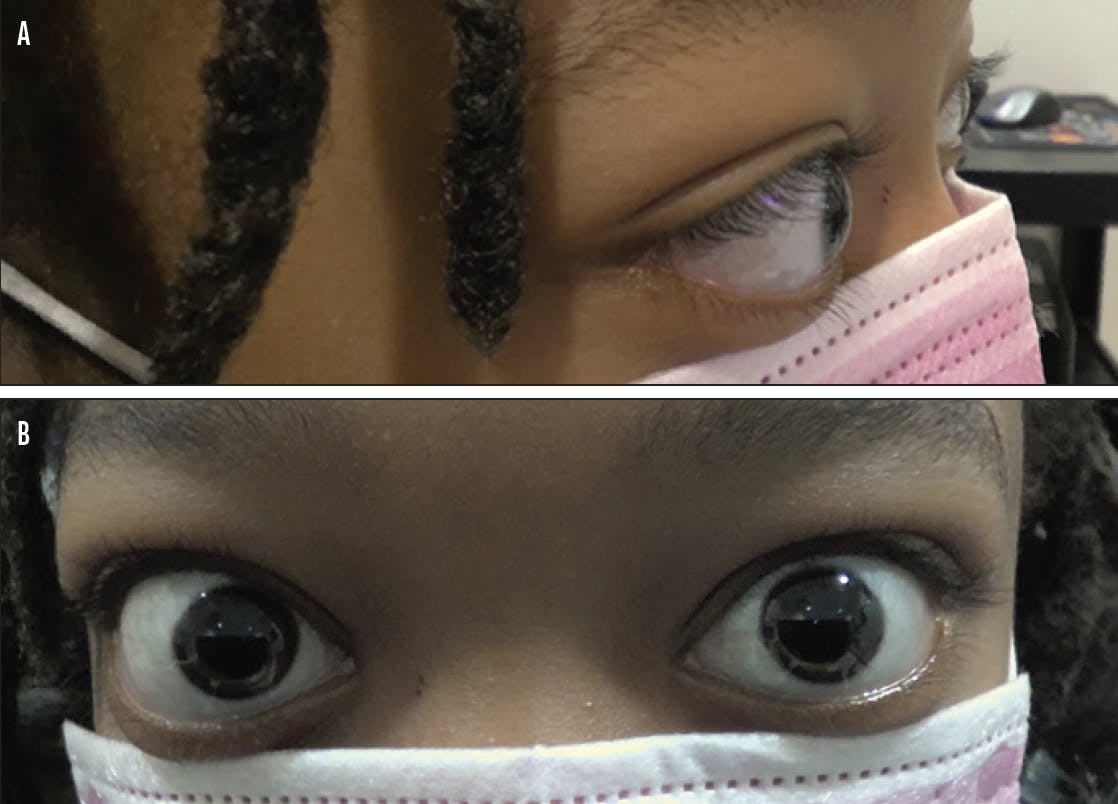 Exophthalmos or Proptosis-Causes-Diagnosis-Best treatment Options | Homeopathic | Best Homeopathic Doctor in Pakistan | Dr Qaisar Ahmed MD, DHMS