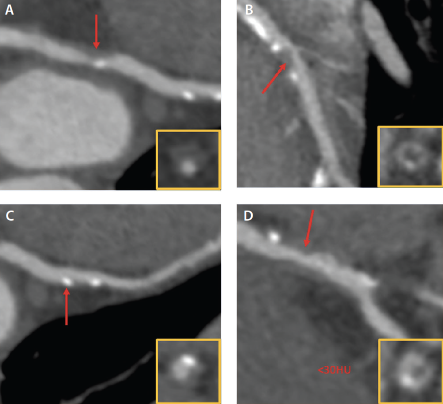 The Role of Coronary CT in Determining LesionSpecific Ischemia and