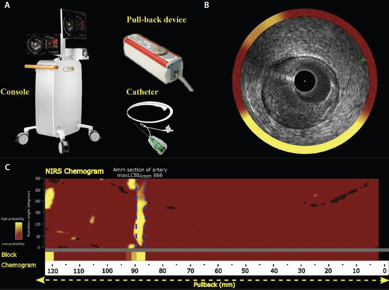 Update On Near-Infrared Spectroscopy/Intravascular Ultrasound - Cardiac ...