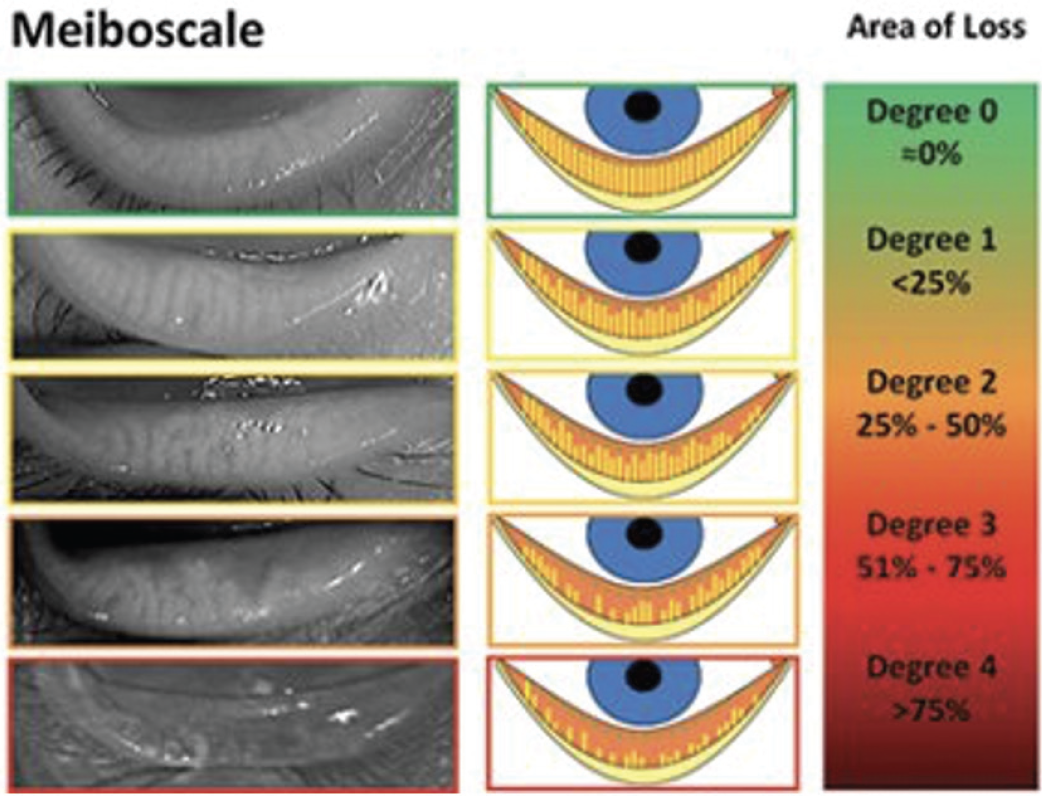 Meibomian Gland Scale