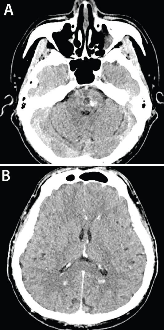 Familial Cerebral Cavernous Malformation Practical Neurology