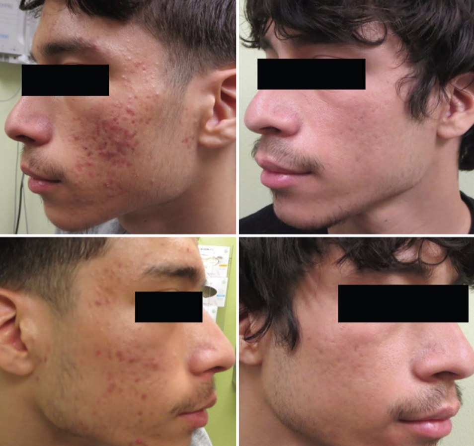 politi Devise eksperimentel Laser Therapy for Atrophic Acne Scars: A Case and Evidence-based Updates -  Practical Dermatology