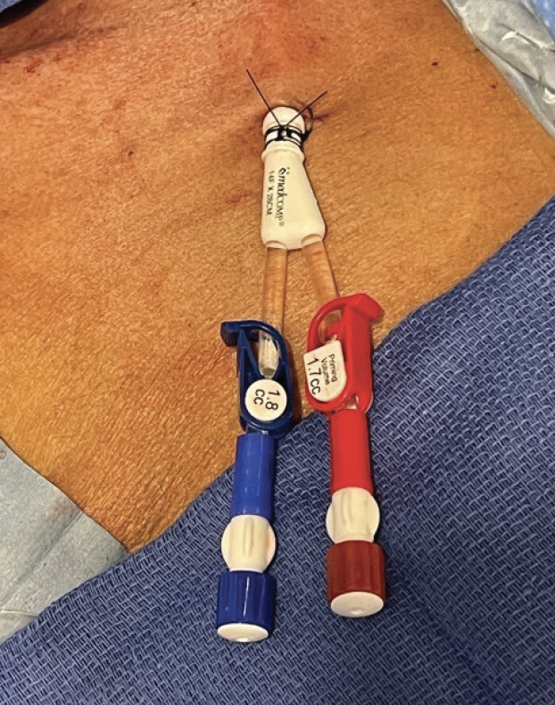 Hemodialysis Tunneled Catheter