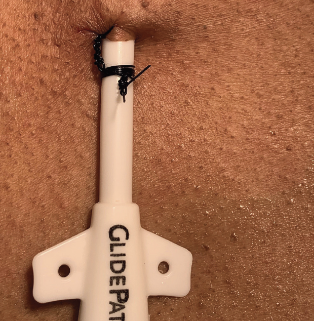 How I Secure a Tunneled Hemodialysis Catheter Endovascular Today