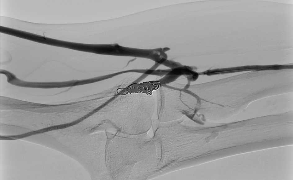 Percutaneous Arteriovenous Fistulas for Dialysis A Case Example and