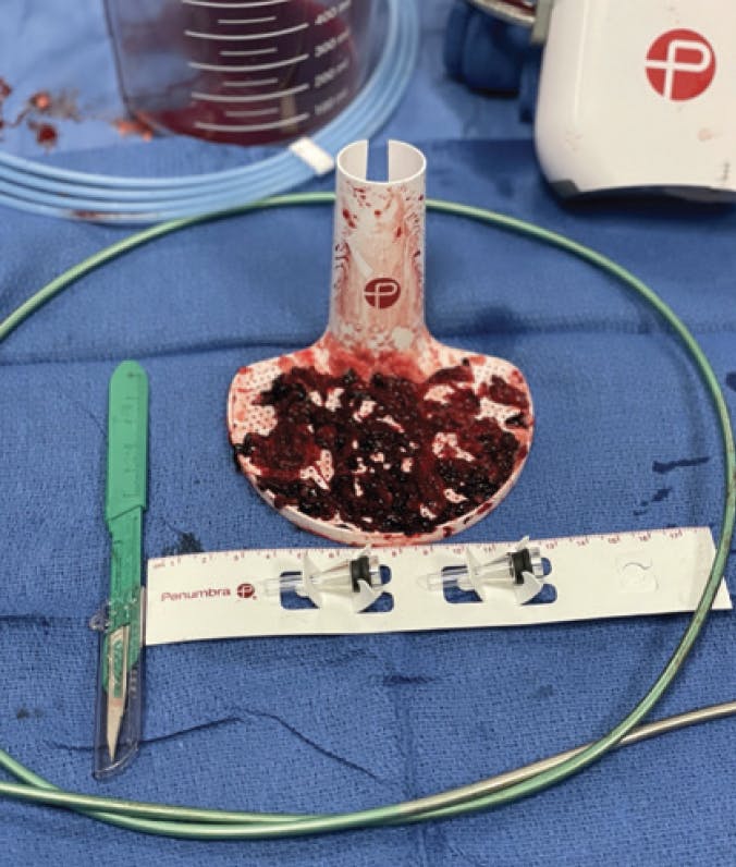 Moving the Peripheral Thrombectomy Field Forward With Computer 