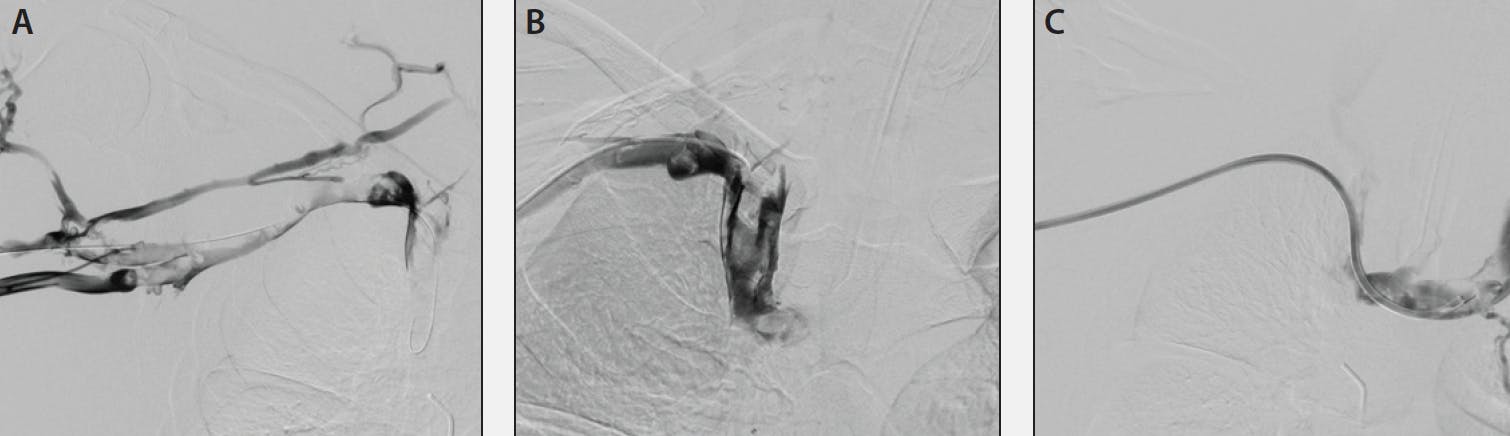 Moving the Peripheral Thrombectomy Field Forward With Computer 