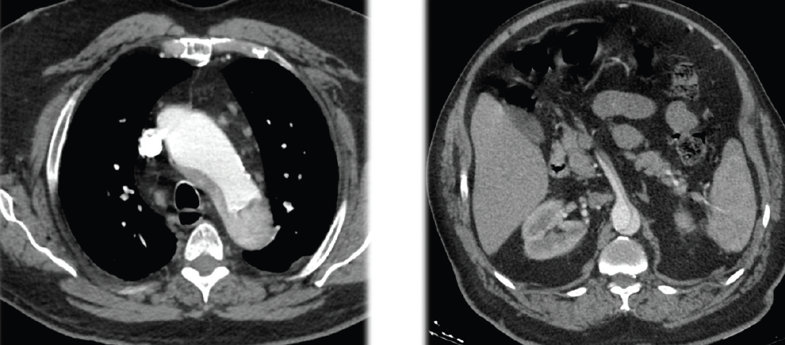 Type B Aortic Dissection And Delayed Mesenteric Ischemia - Endovascular ...