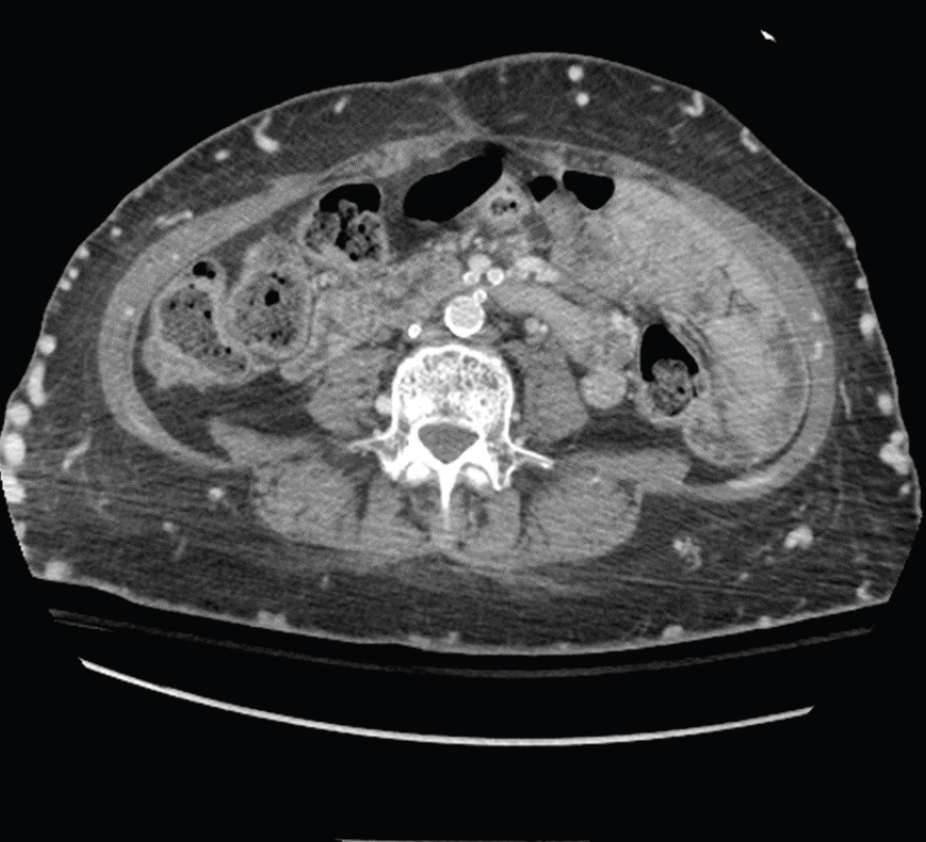 Central Venous Occlusion of the Upper and Lower Extremities in a Young