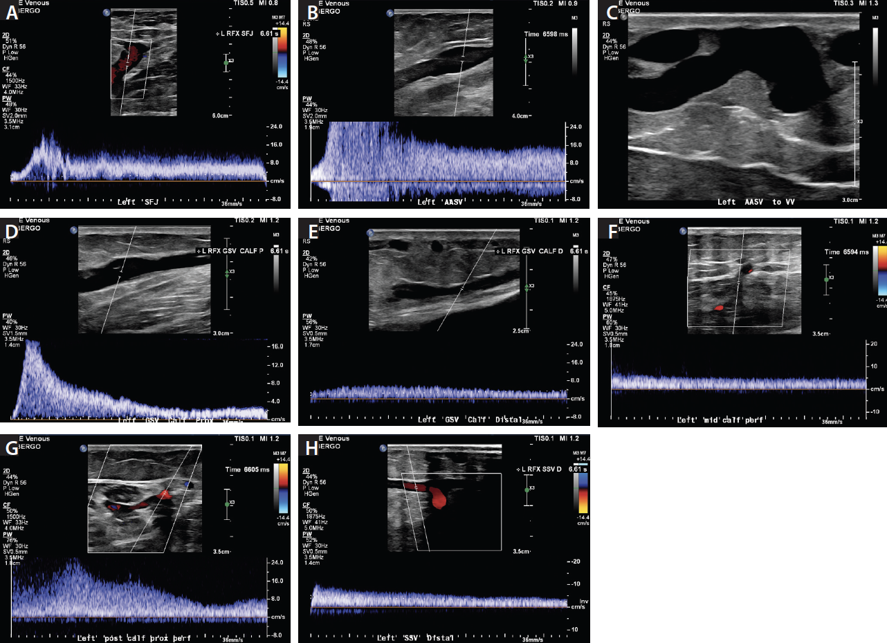 Extensive Venous Reflux and Varicose Veins - Endovascular Today