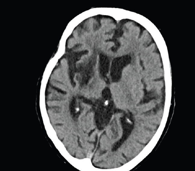 Challenging Mechanical Thrombectomy to Manage an Internal Carotid ...