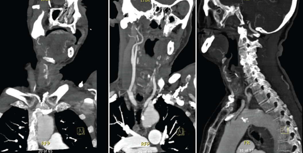 Challenging Mechanical Thrombectomy To Manage An Internal Carotid 