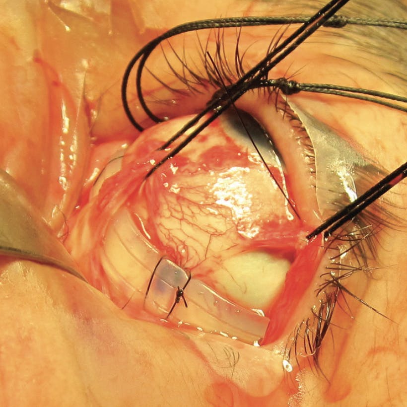 Vitreoretinal Surgery Online - Retina Today