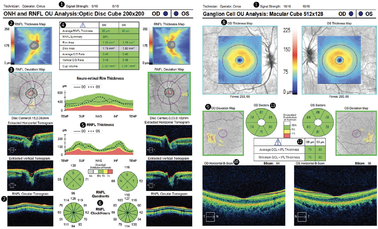 3 Optical Coherence Tomography of the Optic Nerve