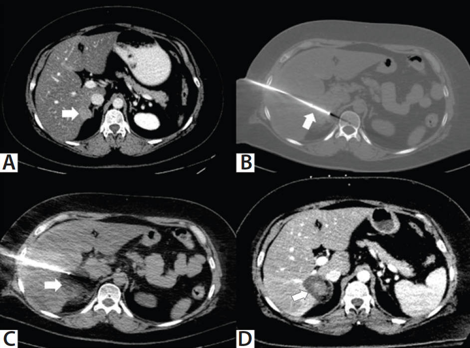 Interventional Oncology for Gynecologic Malignancies - Endovascular Today