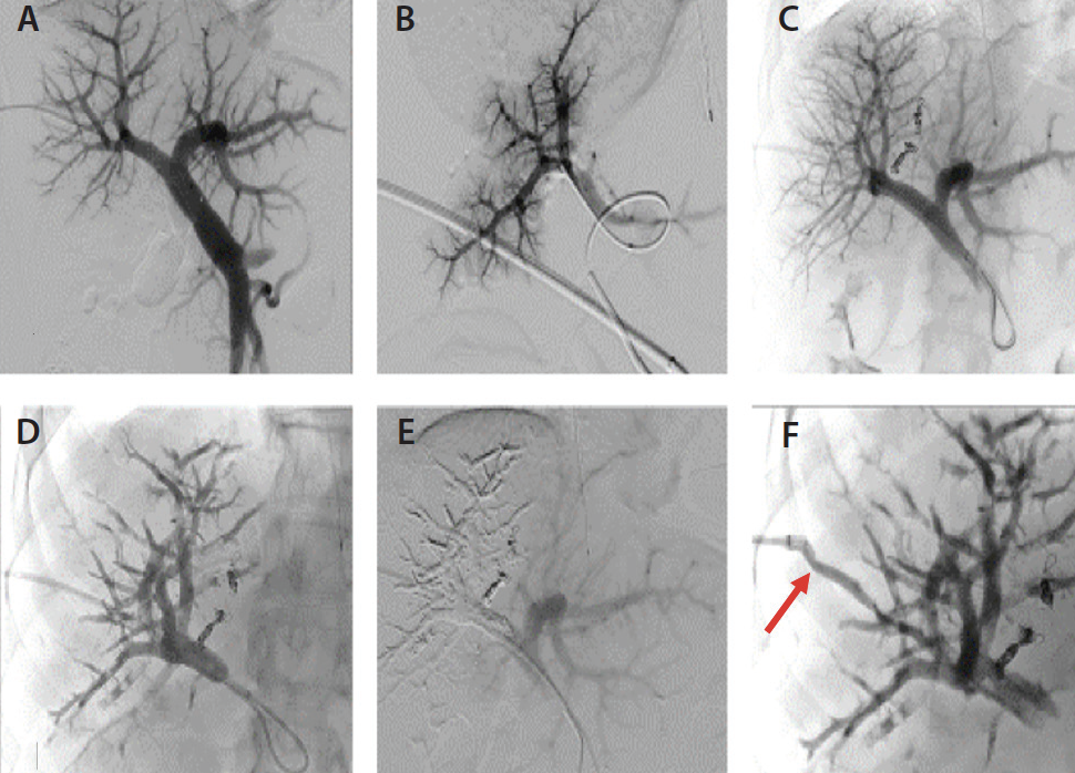 Portal Vein Embolization Plus Hepatic Vein Embolization For Hepatic ...