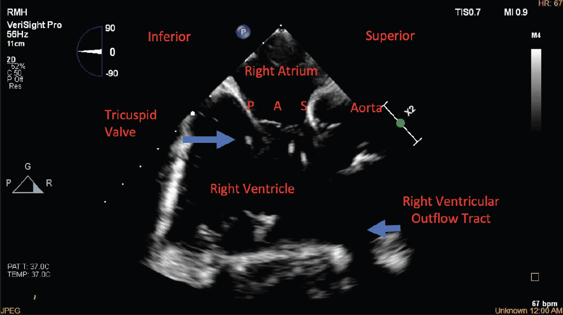 Three Dimensional Intracardiac Echocardiography Use In Tricuspid Valve