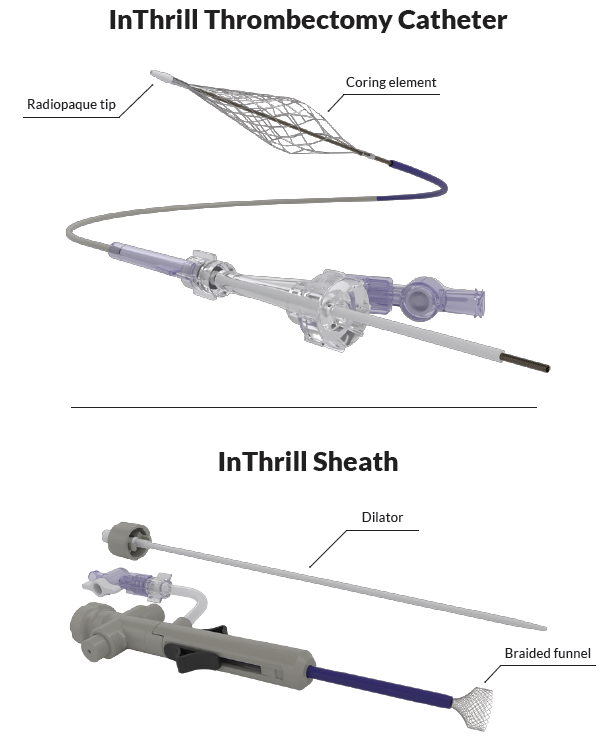 First Reports on the Novel InThrill Thrombectomy System - Endovascular ...