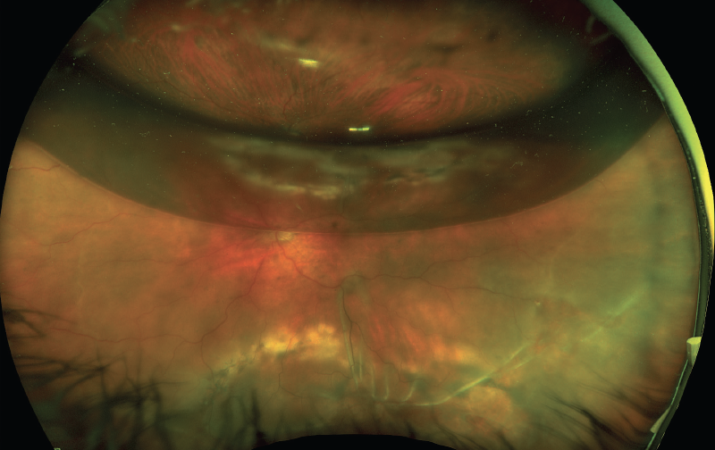 Detached Retina, Optometrist in Chicago, Illinois