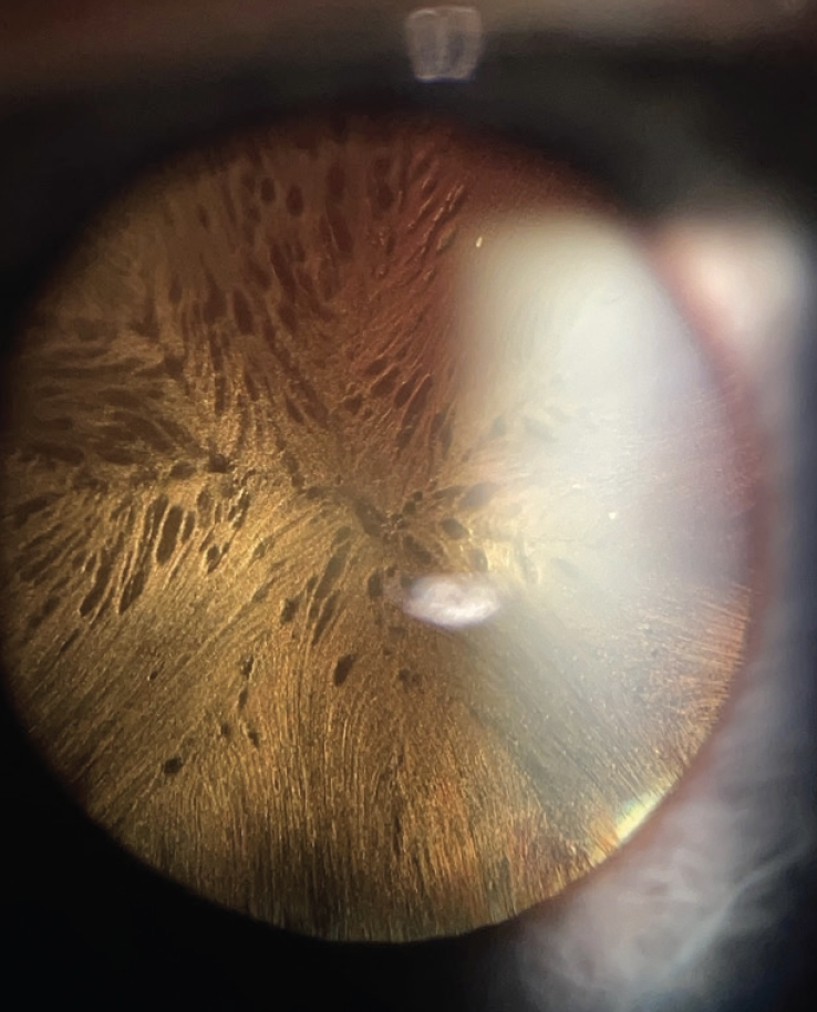 The OD’s Function in Retina Surgery Modern Optometry