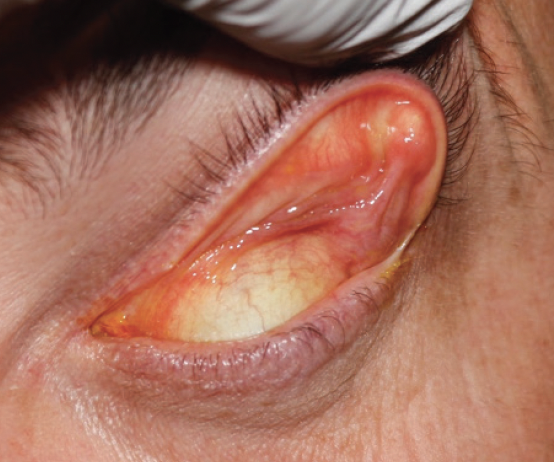 Possible Causes of Dryness and Incomplete Eye Closure after Eyelid Surgery  